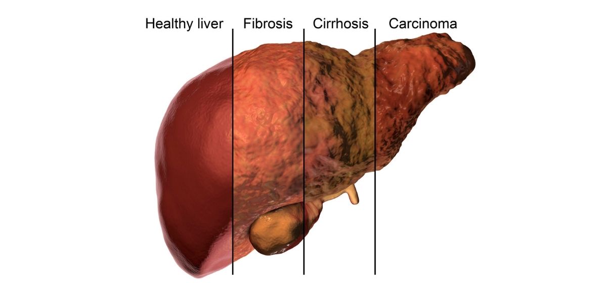 fatty liver diet
